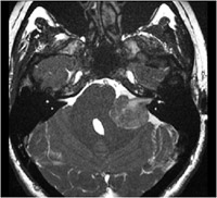 Acoustic neurinoma